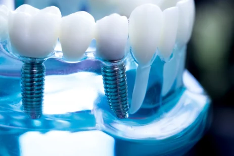 acnis implant dentaire 01